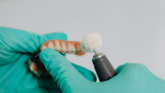 Dental Implants vs Porcelain Veneers – Which is Better?